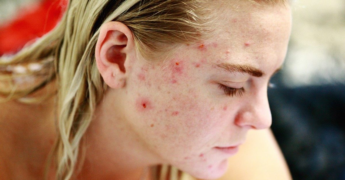 HOW TO GET RID OF PIMPLES NATURALLY AND PERMANENTLY